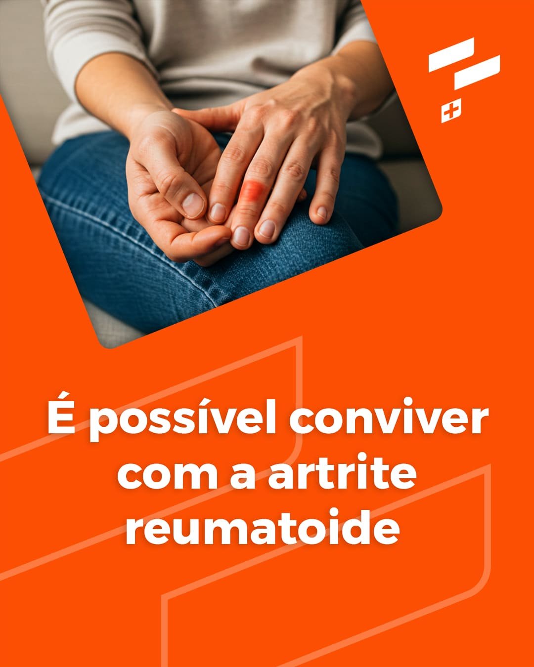 É possível conviver com a artrite reumatoide