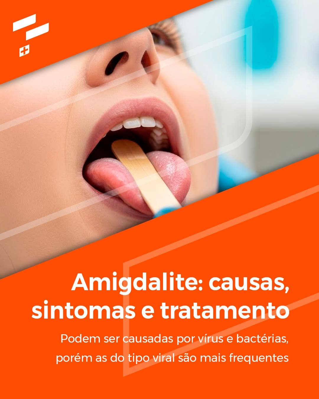 Amigdalite: causas, sintomas e tratamento