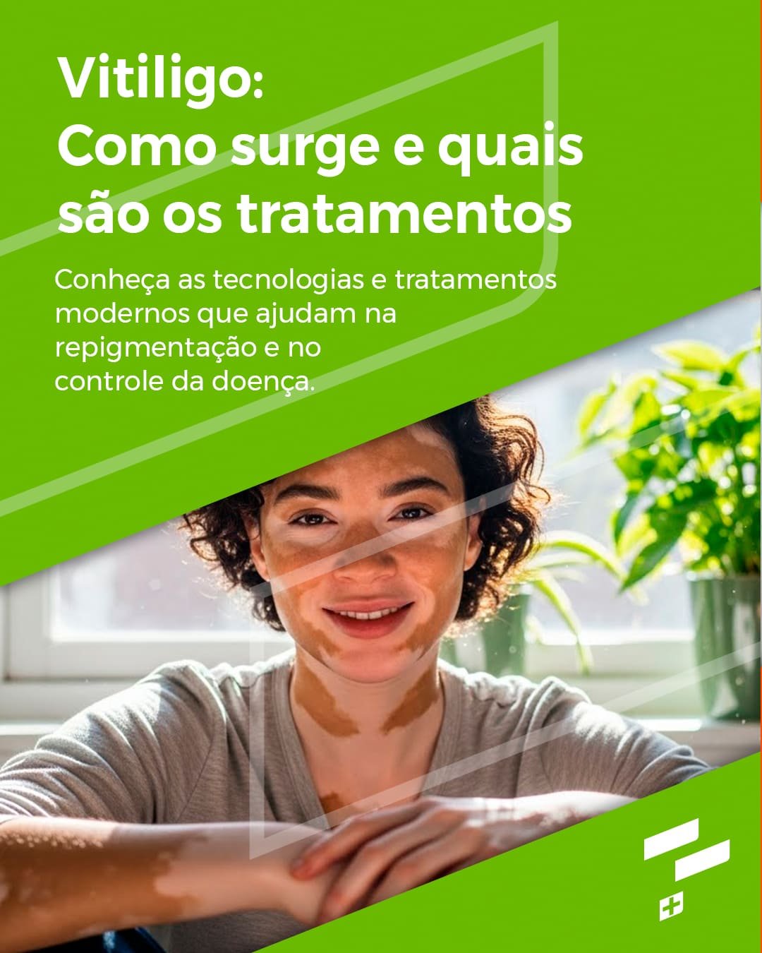 Vitiligo: Como surge e quais são os tratamentos
